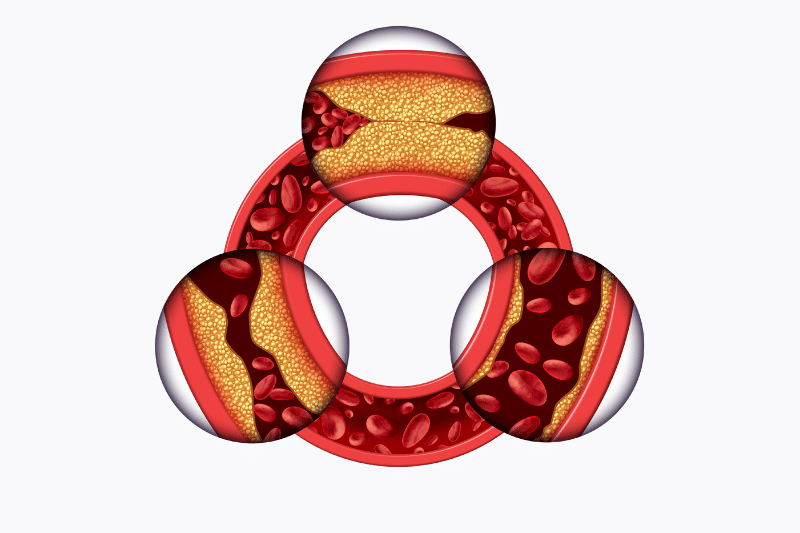 Enfermedad Arterial
