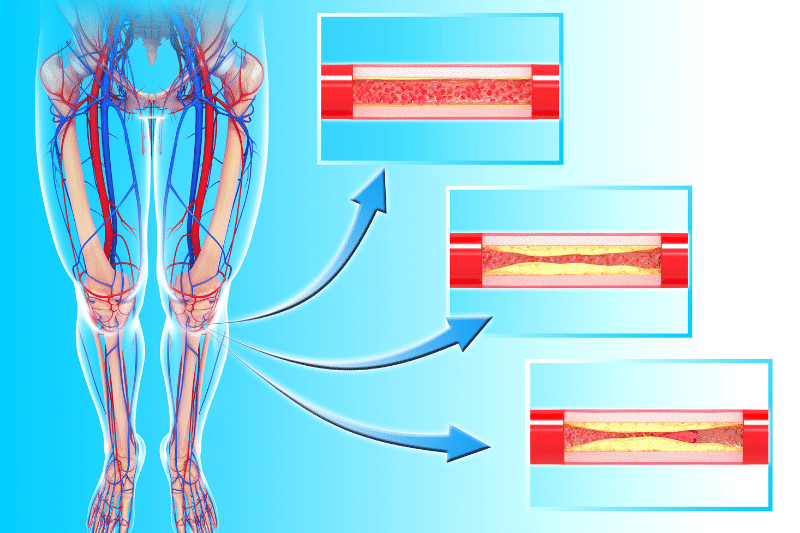 Enfermedad Arterial y Enfermedad Venosa | Causas y tratamientos