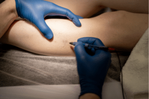 Flebectomía Tratamiento de Arañas Vasculares