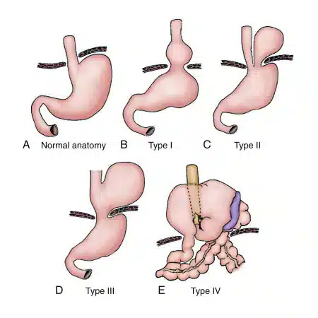 Hernia Paraesofágica