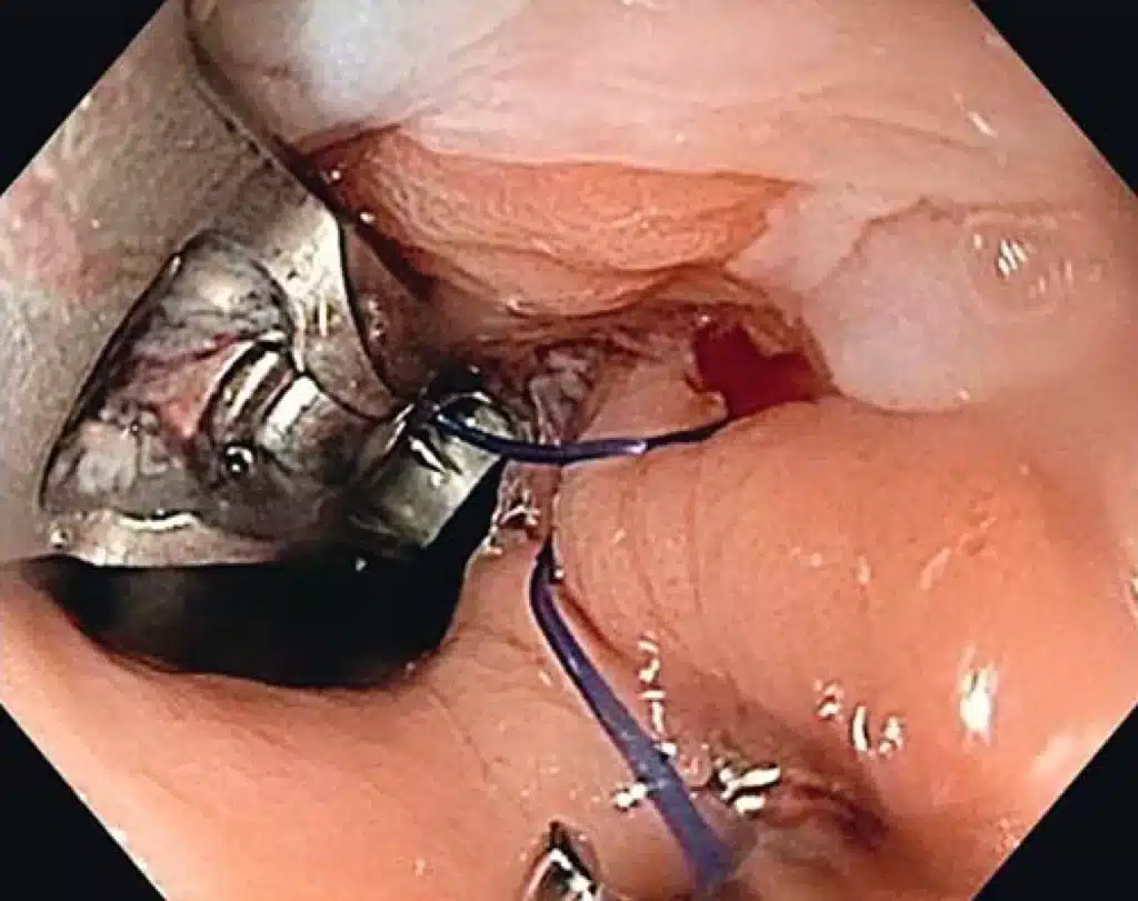 Endoscopic Sphincter Augmentation