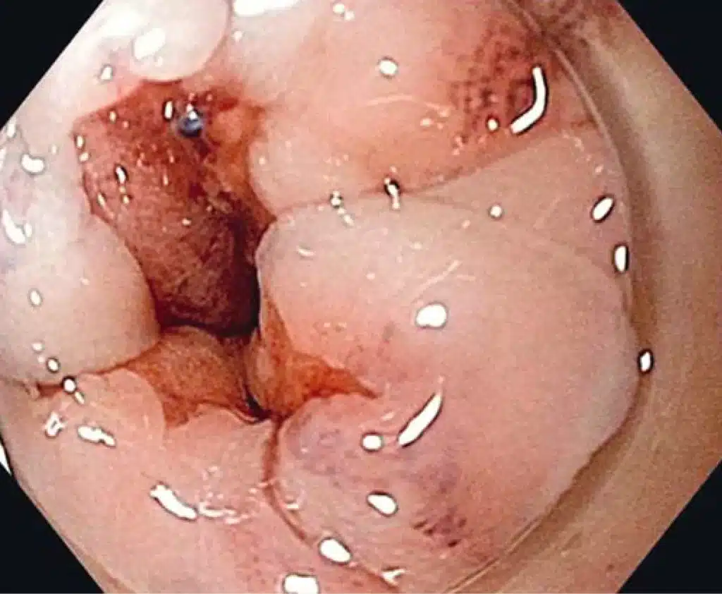 Endoscopic Sphincter Augmentation