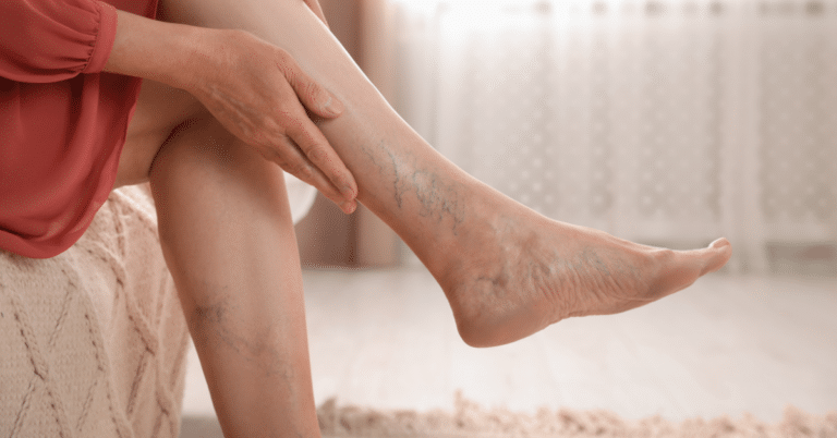 Varicose - Enlarged Vein At Home and Non-Surgical Treatments