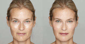 Moms Rejoice Mommy Makeover: Full Body and Face Procedures