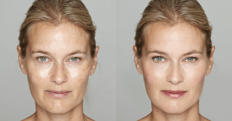 Moms Rejoice Mommy Makeover: Full Body and Face Procedures