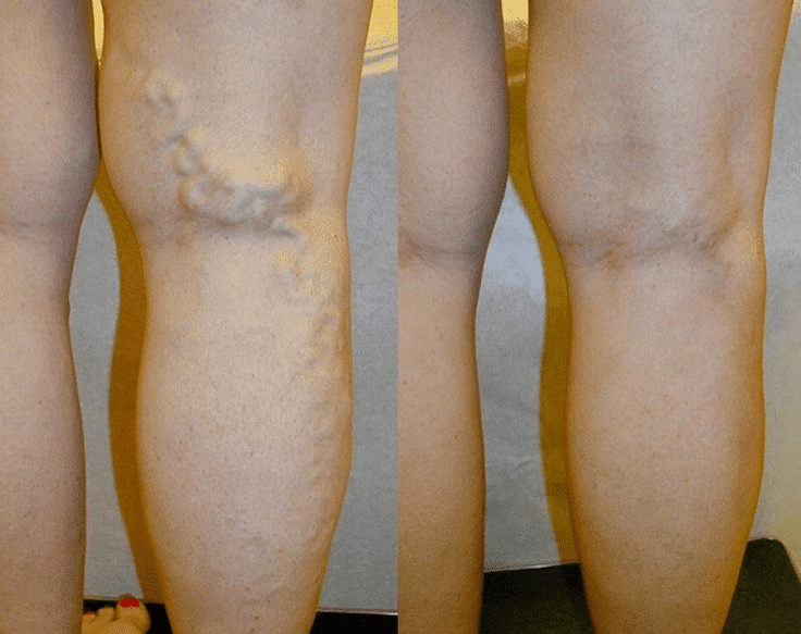Venefit Procedure - Varicose Veins