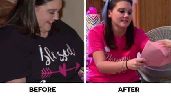 LSG surgery before and after face