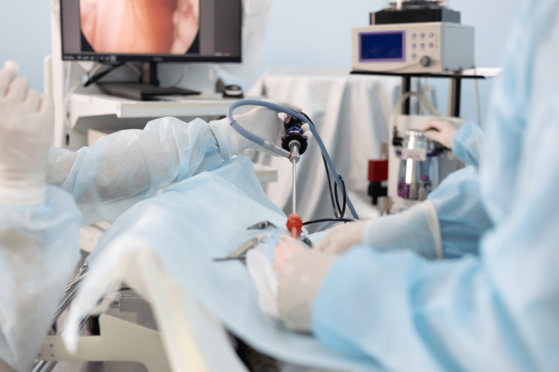 Endoscopic Sleeve Gastroplasty Faqs | Before and After Procedure