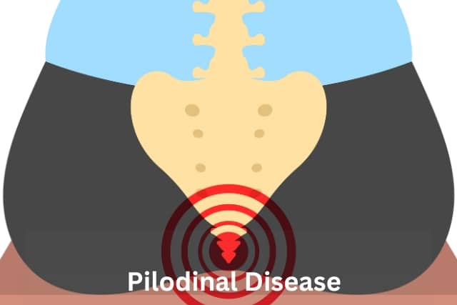 pilonidal disease