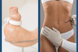 Mommy makeover after bariatric surgery