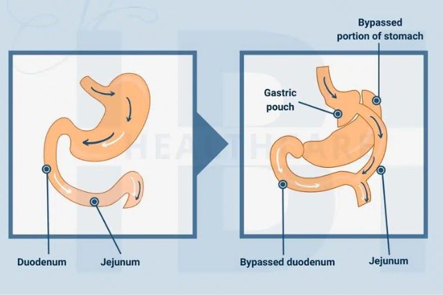 Roux-en-Y (RTGB) Gastric Bypass Anatomy