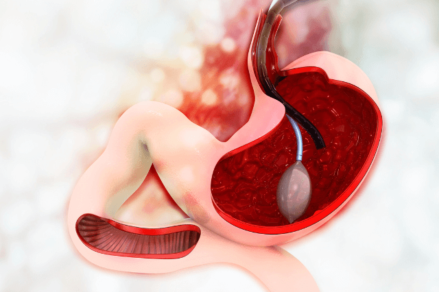 Gastric Balloons for Weight-Loss