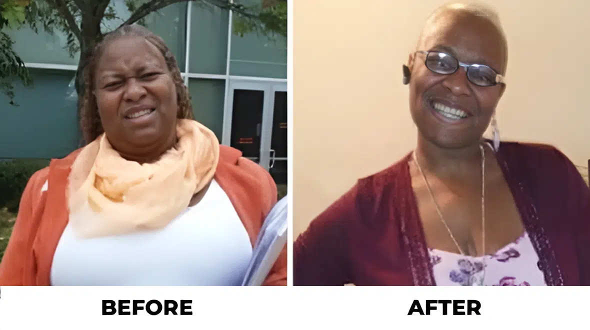 Before and After - Success Stories - Gastric Bypass