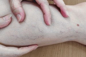 Spider Vein Removal in Georgia