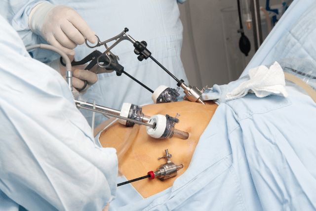 Gastric Bypass vs Sleeve