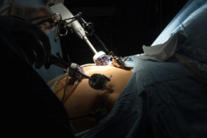 PCOS and Gastric Sleeve