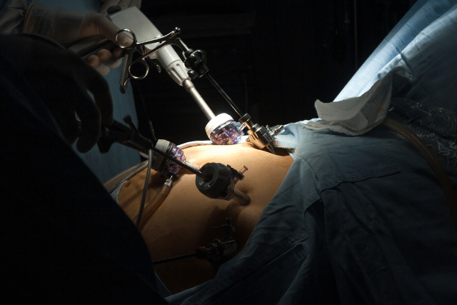 PCOS and Gastric Sleeve