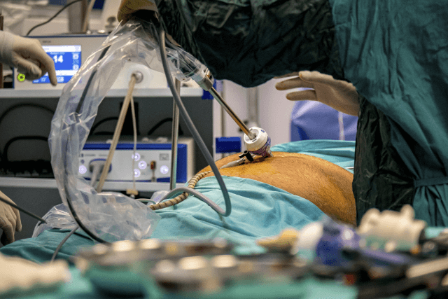 Gastric Bypass Surgery