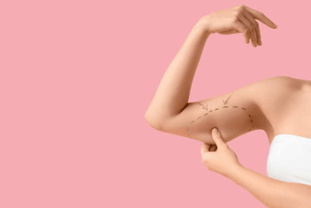 Arm Lift (Brachioplasty)