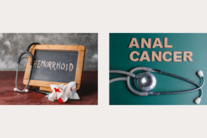 Anal Cancer vs Hemorrhoids