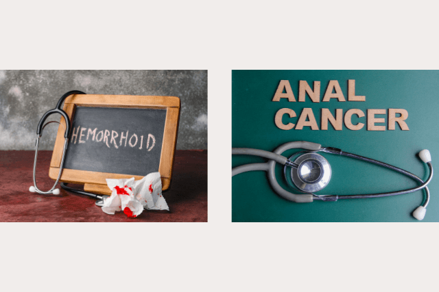 Anal Cancer vs Hemorrhoids