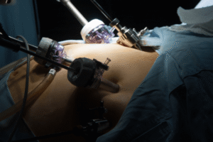 Who Is a Good Candidate for Gastric Bypass