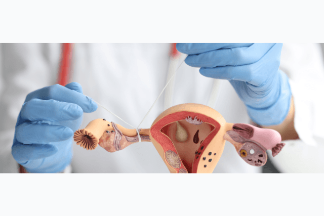 Candidate for Tubal Reversal
